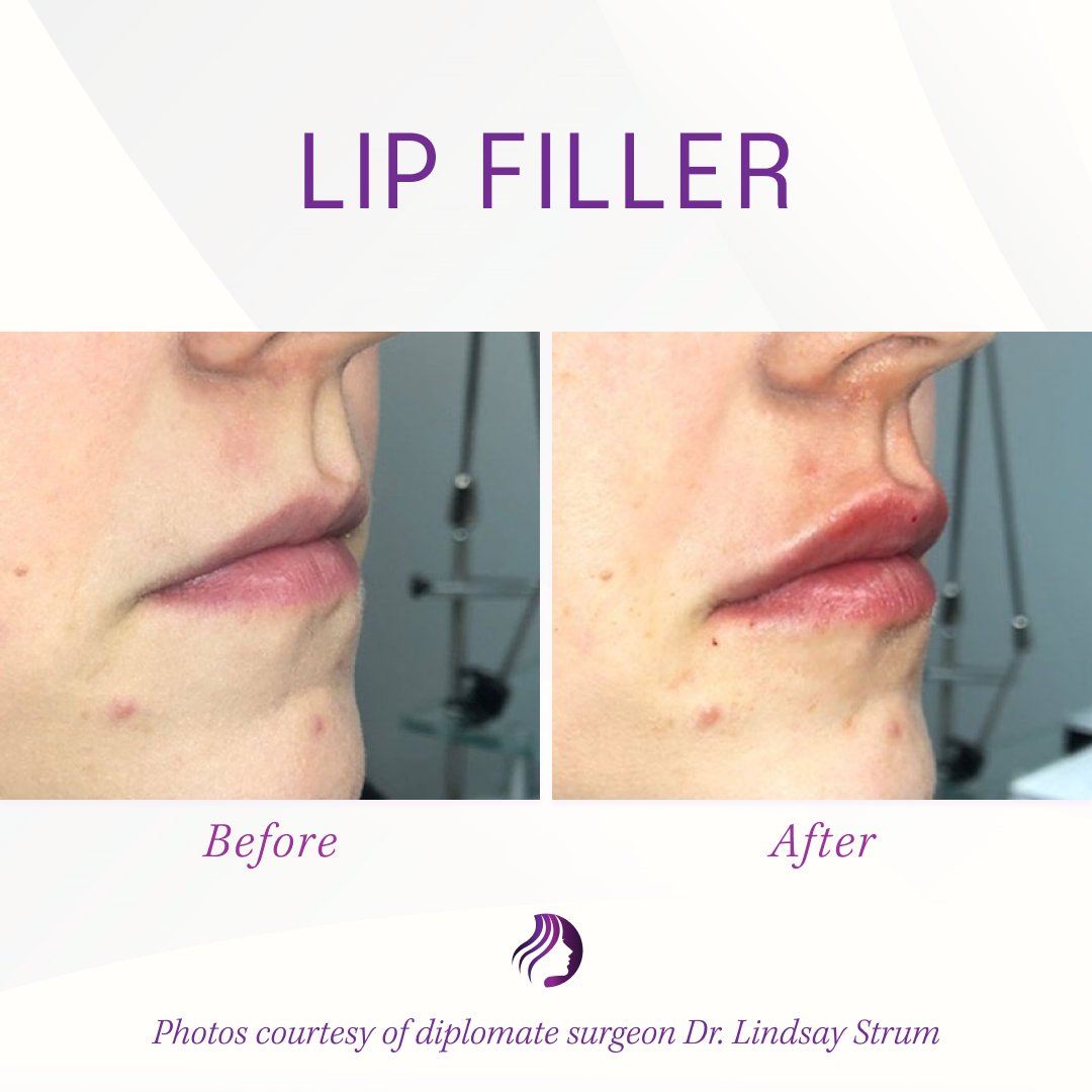 ABFCSorg's tweet photo. Beautiful, natural-looking #LipFillerResults from Dr. Lindsay Sturm of Sturm Cosmetic Surgery. 

💭 Dr. Sturm says, “Being able to give confidence back to patients and giving someone the ability to feel comfortable and confident in their own skin is an indescribable feeling!” https://t.co/qZ8qdoQtGo