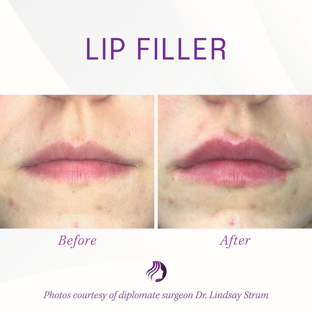 ABFCSorg's tweet photo. Beautiful, natural-looking #LipFillerResults from Dr. Lindsay Sturm of Sturm Cosmetic Surgery. 

💭 Dr. Sturm says, “Being able to give confidence back to patients and giving someone the ability to feel comfortable and confident in their own skin is an indescribable feeling!” https://t.co/qZ8qdoQtGo
