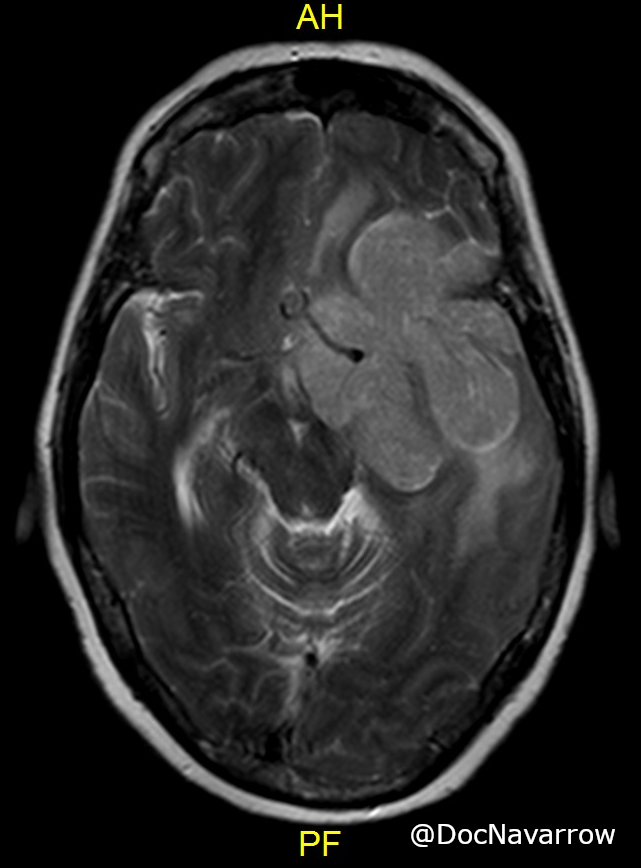 DocNavarrow's tweet photo. Does anyone else see a clover leaf in this sphenoid wing meningioma? 🧠🤔
#Neurorad #NeuroRx https://t.co/dQ2utyQVUv