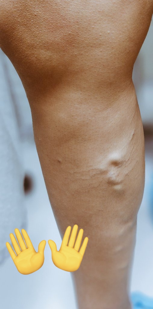 ihara_vascular's tweet photo. #varices #cirugiavascular https://t.co/JDW7TAA6ov