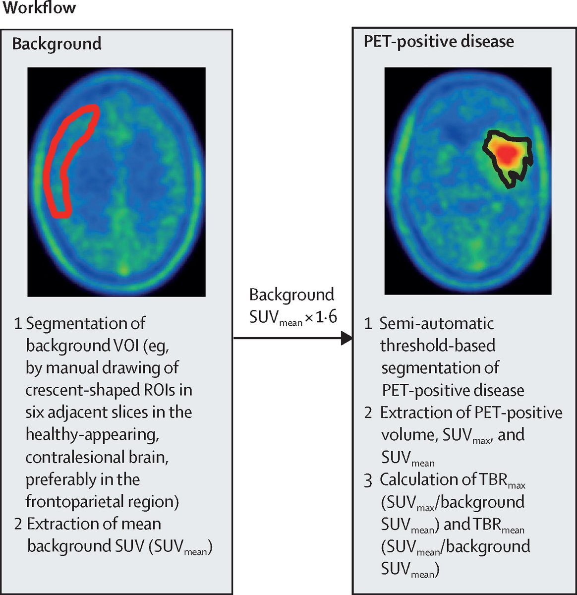 TheLancetOncol's tweet photo. NEW: RANO propose a set of criteria for response assessment based on amino acid PET imaging in clinical trials enrolling participants with diffuse gliomas.

https://t.co/z4AsCEuK8G https://t.co/3NQ5eTjfGn