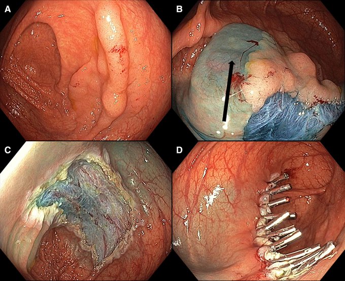 sepdigestiva's tweet photo. #GUTImage from @Gut_BMJ

"Endoscopic mucosal resection for large non-pedunculated colorectal polyps: staying on track with a safe, effective and cost-efficient technique" via

https://t.co/b6QUzLsSav

#EMR #Polyps @JuGauc https://t.co/hIVPJ3drcw