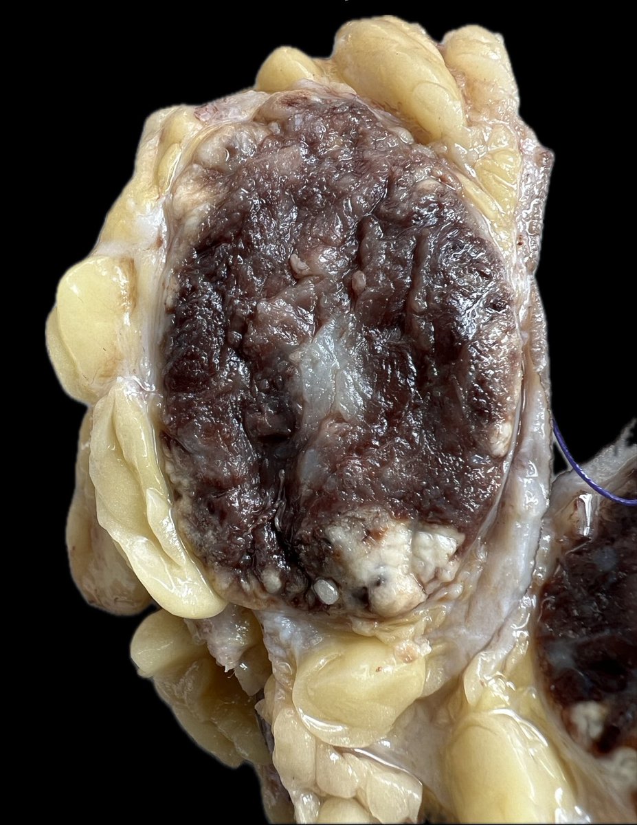 Immanuel_Paul30's tweet photo. Solid | Tan Brown | Circumscribed
What could this be ?
💭 on site and diagnosis
#Whatcouldthisbe
#impathgross #PathTwitter https://t.co/0MxJN0nkAf