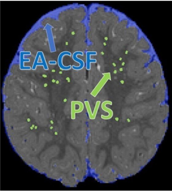 Enlarged perivascular spaces in infant brains linked to autism risk #radiology #MRI @UMC bit.ly/48llEpn