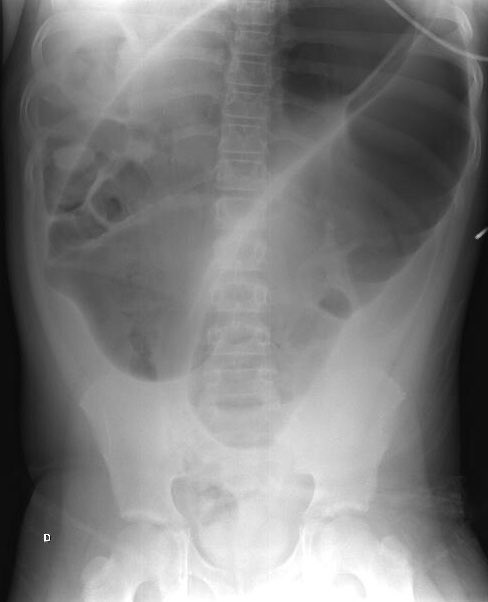 GesconsEduca's tweet photo. 🎯 Paciente presenta: 

✏️ Dolor abdominal 
✏️ Vómito
✏️ Hipotensión 

🧩 RX de tórax https://t.co/wopoDAp6ts