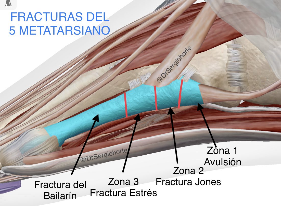 DrSergiohorte's tweet photo. 🔴FRACTURAS 5 METATARSIANO🔴

▪️ZONA I: Fractura avulsión de la base

▪️ZONA II: Fractura de Jones metafisodiafisaria

▪️ZONA III: Fractura de Estrés diafisaria

▪️FRACTURA DEL BAILARÍN

🟣No confundir fracturas Zona I con el OS VESALIANUM, hueso accesorio https://t.co/ef1kq2Zbwn