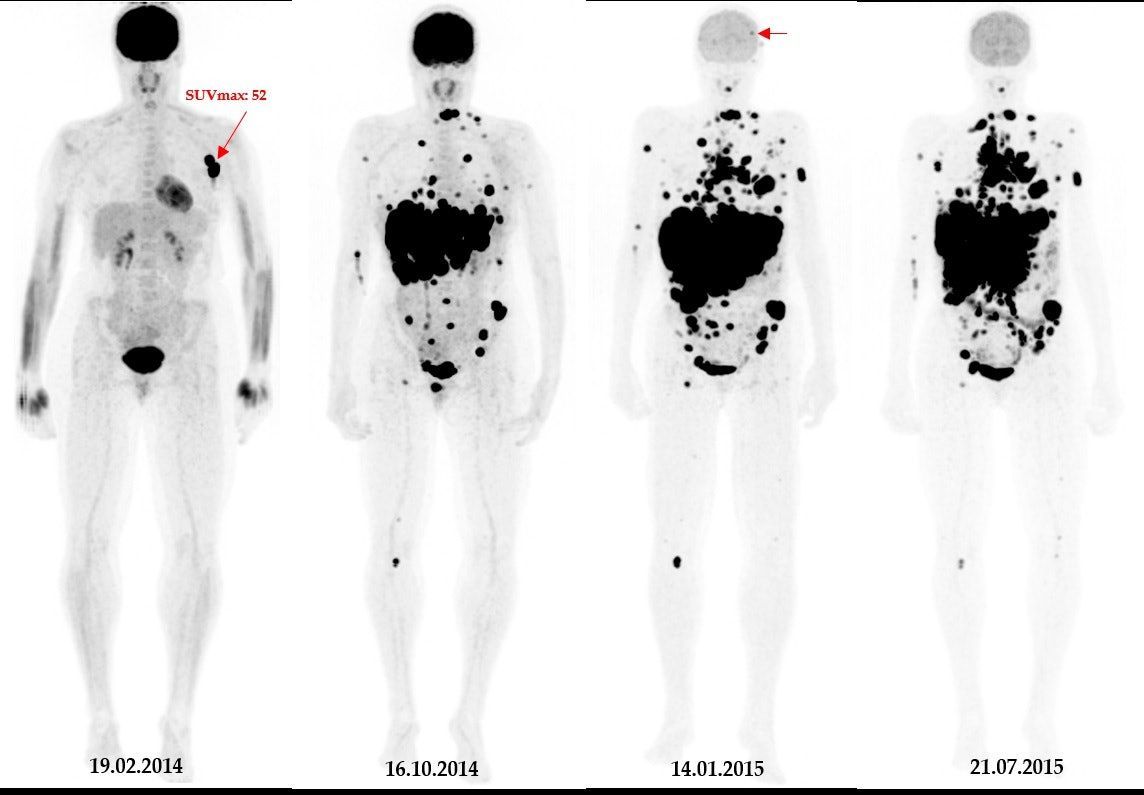PET/CT predicts brain tumors in melanoma patients #radiology #PETCT bit.ly/3H268mq