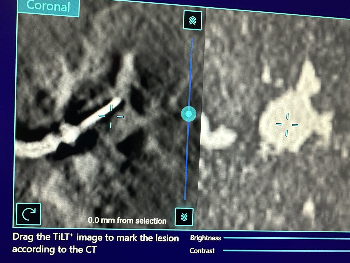Bhadra & Condra CBCT Bronchoscopy tweet media