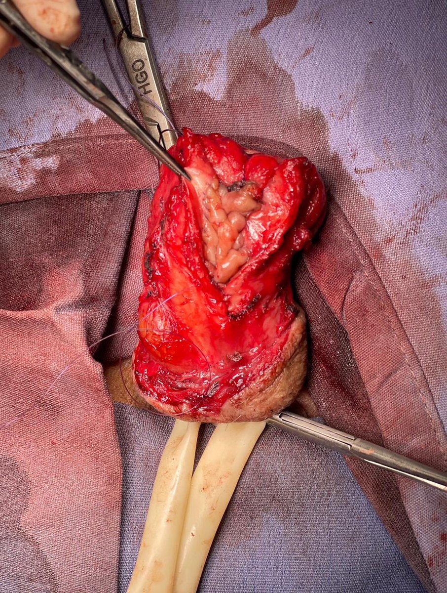 Un caso complejo, posqx 2 Rtup, meatotomia y dorsoplastia. Todo esto hizo que se fusionara el glande con prepucio más estenosis peneana distal. Le realizamos una reconstrucción con BMG uretral y remodelación de glande.