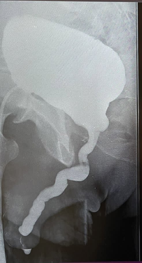 drecabeza's tweet photo. Un caso complejo, posqx 2 Rtup, meatotomia y dorsoplastia. Todo esto hizo que se fusionara el glande con prepucio más estenosis peneana distal. Le realizamos una reconstrucción con BMG uretral y remodelación de glande. https://t.co/jagr5xuYzL