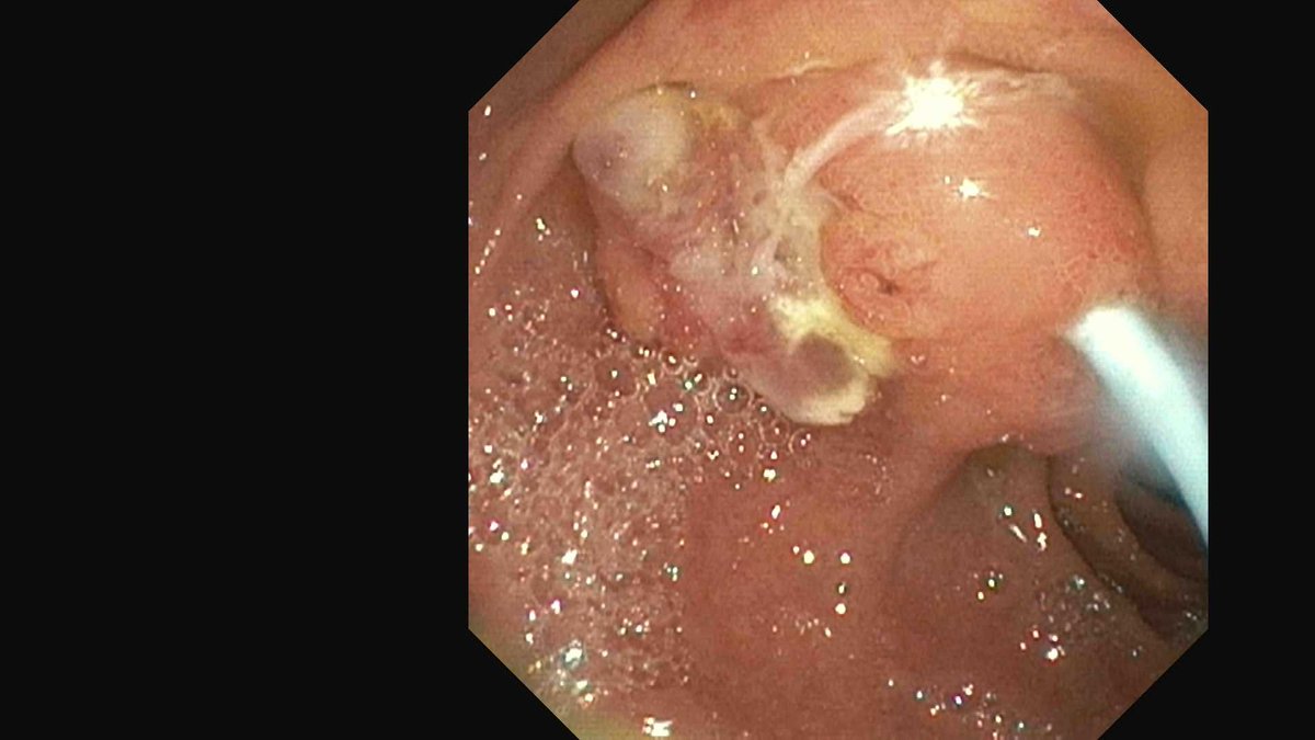 Douglas G. Adler MD, FASGE, FACG, AGAF (@douglasadlermd) on Twitter photo Pancreatic cancer eroding through the ampulla creating a fistula from the CBD. #gitwitter #oncology #surgery <a href="/asge/">Aslak Gottlieb</a> #gie #pancreas Pancreatic cancer eroding through the ampulla creating a fistula from the CBD. #gitwitter #oncology #surgery <a href="/asge/">Aslak Gottlieb</a> #gie #pancreas