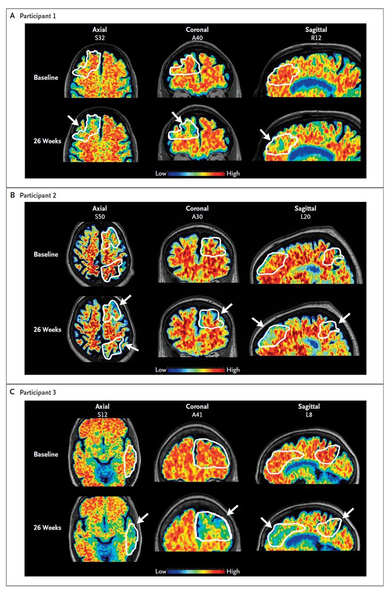 In three patients with Alzheimer’s disease, focused ultrasound was applied with aducanumab therapy. Reduction in amyloid was greater in treated regions than in matched contralateral regions over 6 months. Read the full report: nej.md/3vmOEP4