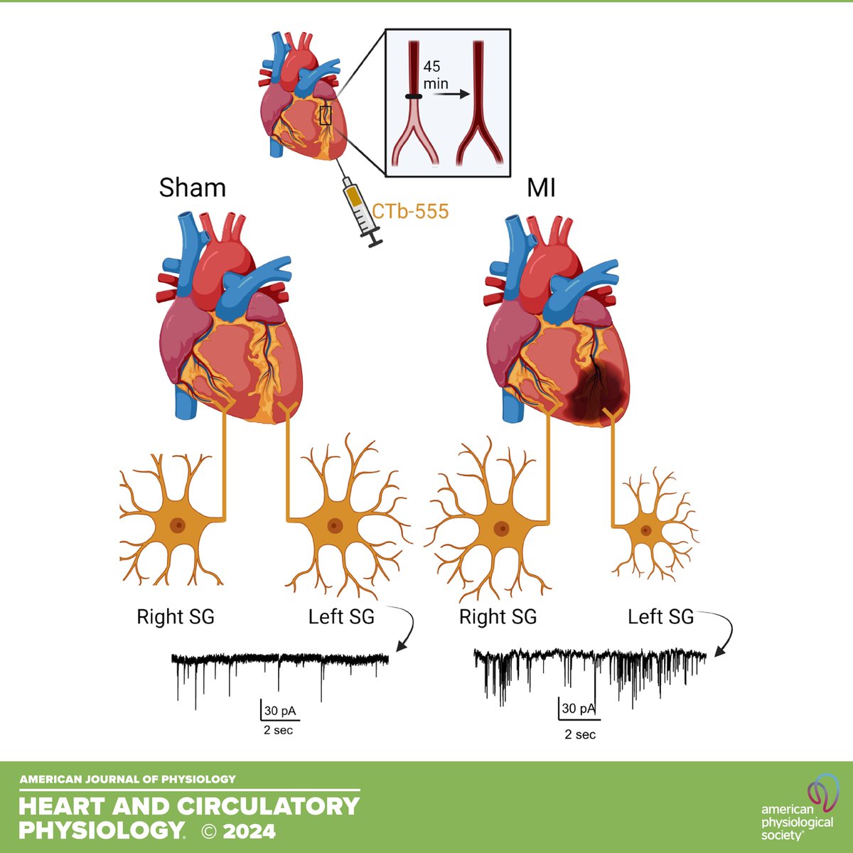 ajpheartcirc's tweet image. *️⃣FREE Article of the Week*️⃣

Ischemia-reperfusion myocardial infarction induces remodeling of left cardiac-projecting stellate ganglia neurons
Barrett et al. @OHSUNews
🔓ow.ly/lF5m50Qnpf5

#HeartFailure  #Cardiomyopathy  #NeuralPlasticity