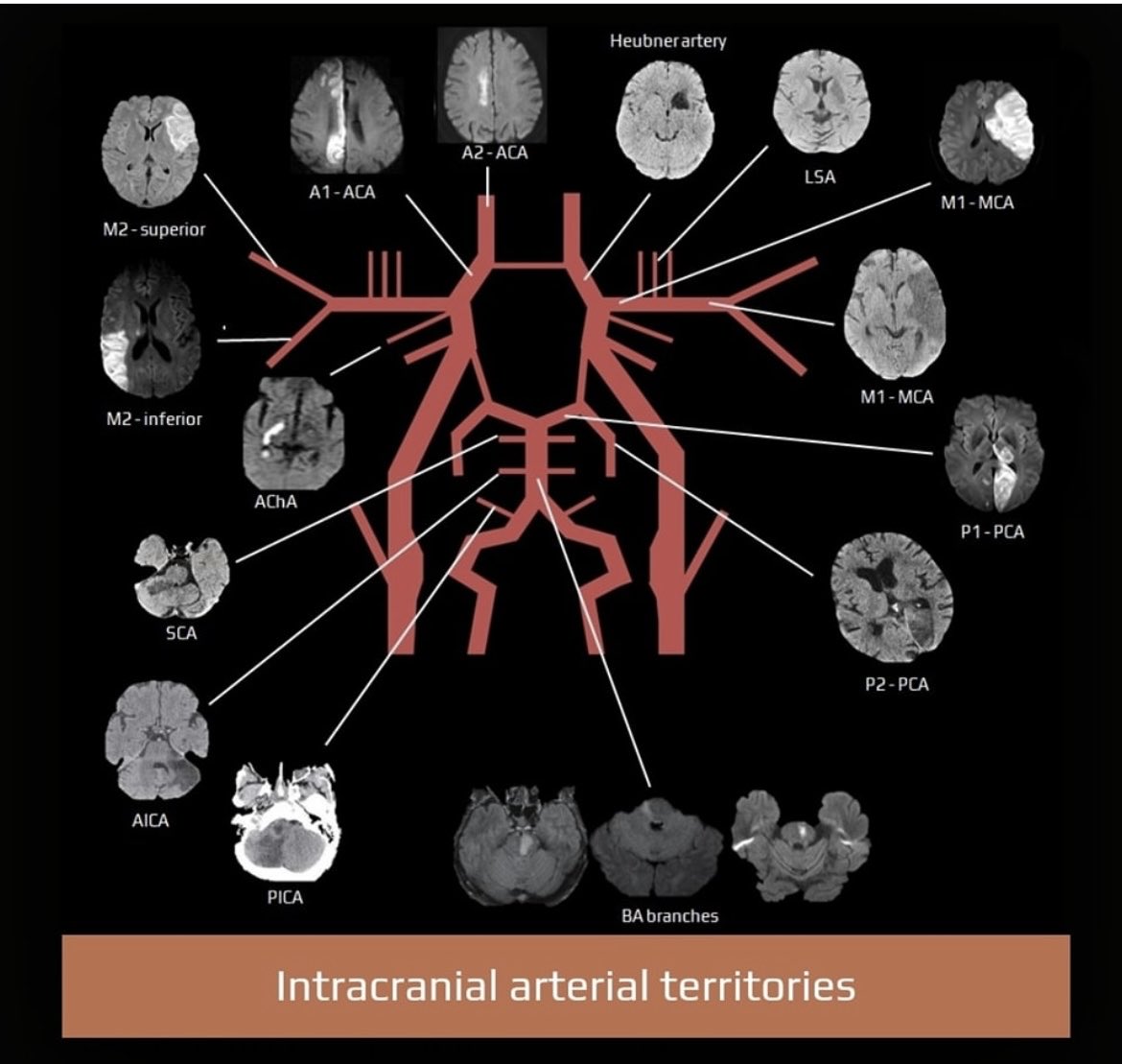 Great one on Intracranial Arterial Territories and strokes  h/t radio anatomy app