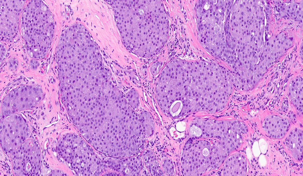 MhPathology's tweet image. 65-year-old female with abnormal mammogram
Diagnosis: Invasive ductal carcinoma with apocrine features #PathTwitter #medpath
