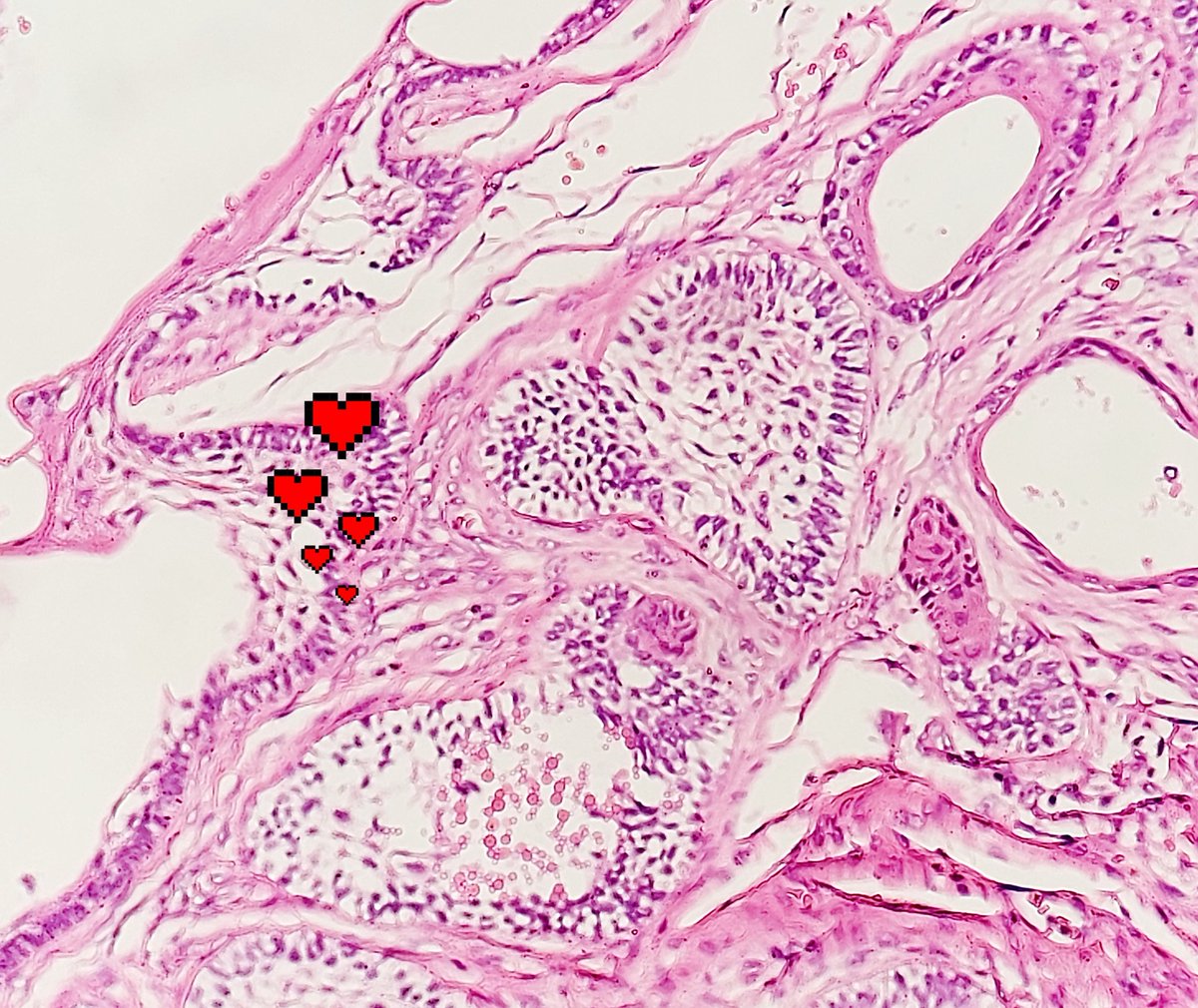 padmapathology1's tweet photo. #ThursdayMotivation
#sendinglove
Reverse polarity in Ameloblastoma
#PathTwitter #TooCuteNotToShare #headandneckpath https://t.co/bFcfFogt5b