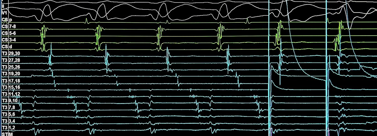 DrRoderickTung's tweet image. Delicious holiday feast for 2024! 🍽️First diastolic buffet of the year with some mechanistic desserts at the end.  Comments👇 Incessant VT no longer. #ablateVT ⁦@JakeCMartinez⁩ ⁦@DrKatrapati⁩ @DrByronReichert