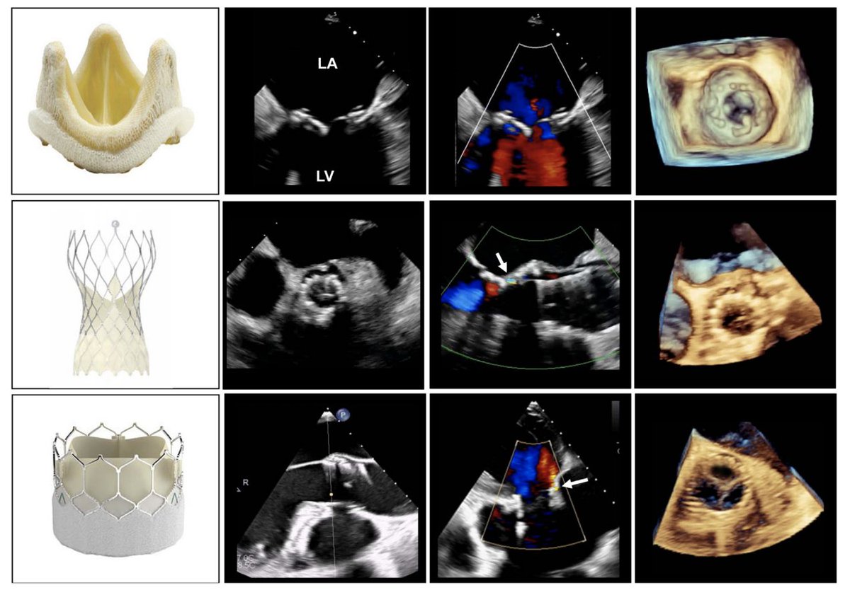 💫NEW💫 ASE prosthetic valve guidelines published in @JournalASEcho @ASE360 Congratulations coauthors @PeiNiJone @WilliamZoghbi @dysanborn @tiffchenMD @SangeetaCardsMD @JeremyThaden @SLittleMD @hahn_rt @p_grayburn @edwardagill @KeithC_echo @mswami001 ➠ bit.ly/3RJxmTB