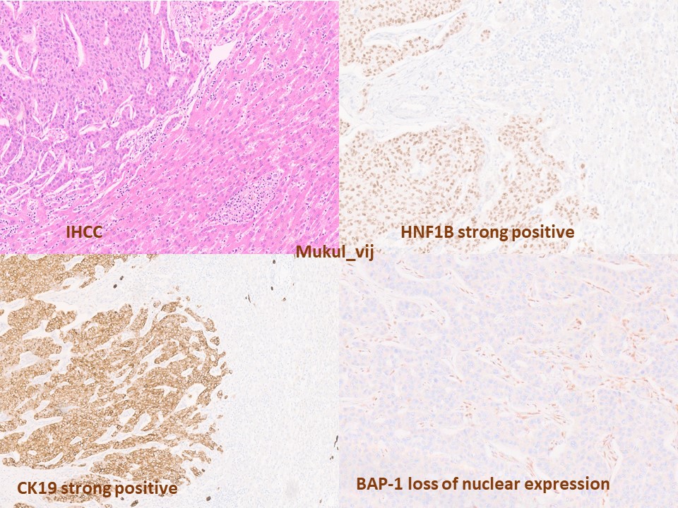 BAP-1 loss in intrahepatic cholangiocarcinoma (IHCC)
Loss of nuclear staining for BAP1 IHC correlates strongly with BAP1 mutation in IHCC
BRCA1-associated protein 1 (BAP1)
Tumor suppressor gene
Nuclear deubiquitinating enzyme
Encoded by the BAP1 gene at 3p21.1
Involved in…