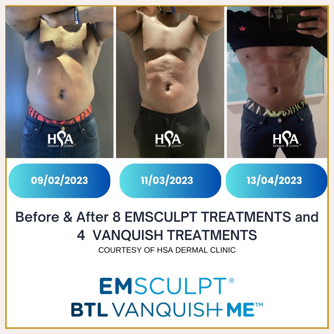 hsadermal's tweet photo. Excited to share the incredible journey of our client who embarked on a non-invasive body sculpting revolution with us! After 8 sessions of Emsculpt sculpting those muscles and 4 rounds of BTLVanquish torching the fat, the results are nothing short of AMAZING! #BodyTransformation https://t.co/CsoondswoV