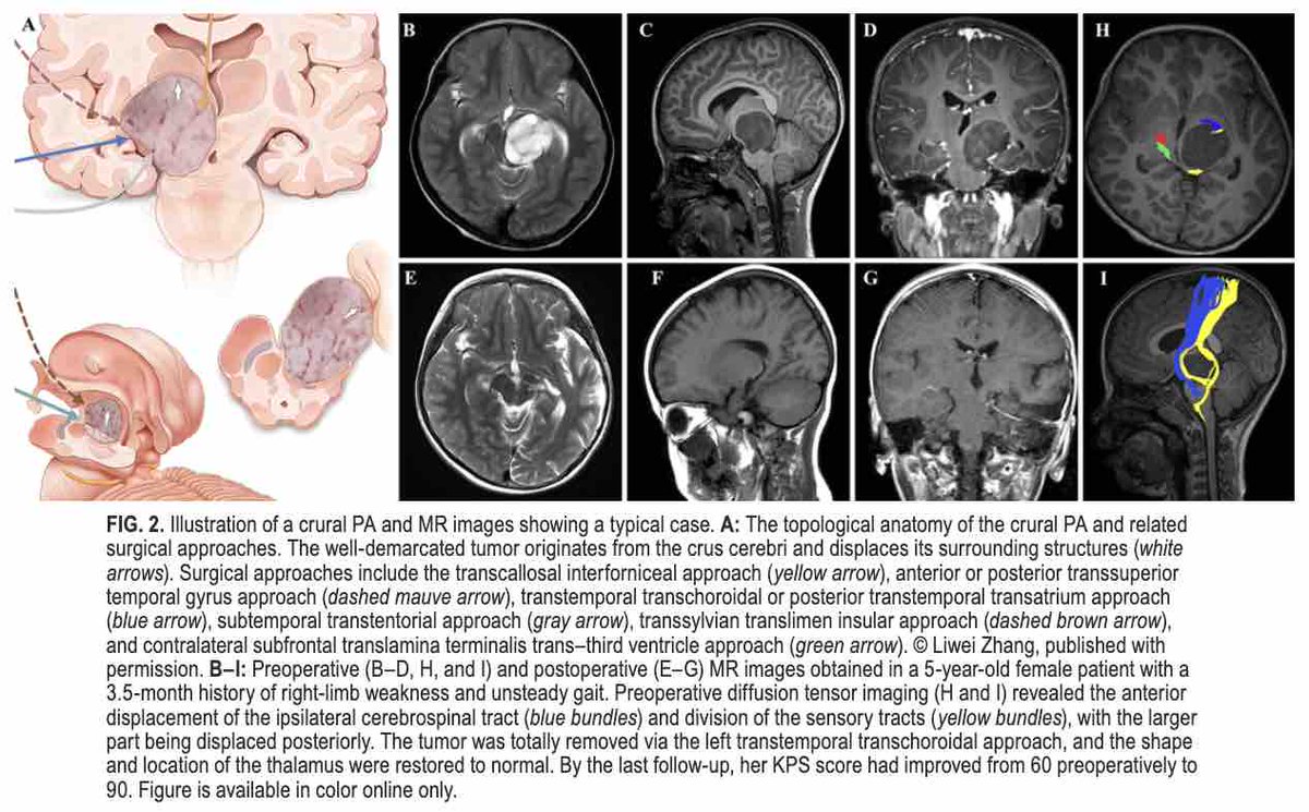 TheJNS's tweet photo. #OnlineFirst: A novel radiological classification of midbrain pilocytic astrocytomas and its implication for surgical management: a single-institution experience of 57 cases. 

https://t.co/Ogw2puKb4B. https://t.co/MuvxPrJuD0