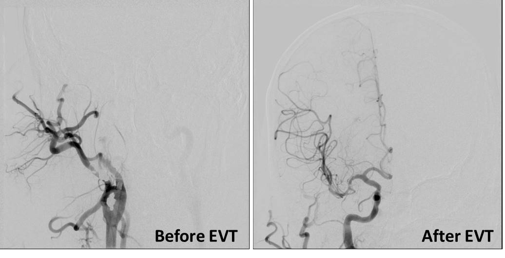 Yalda night, the longest night of the year, is also long enough for a large vessel occlusion #stroke to happen. Tandem ICA-MCA occlusion. Substantial (TICI2b) recanalization at Imam Khomeini Hospital. Dr Torkaman and Dr Jamali, our good fellows. @MThrombectomy @SurviveStroke