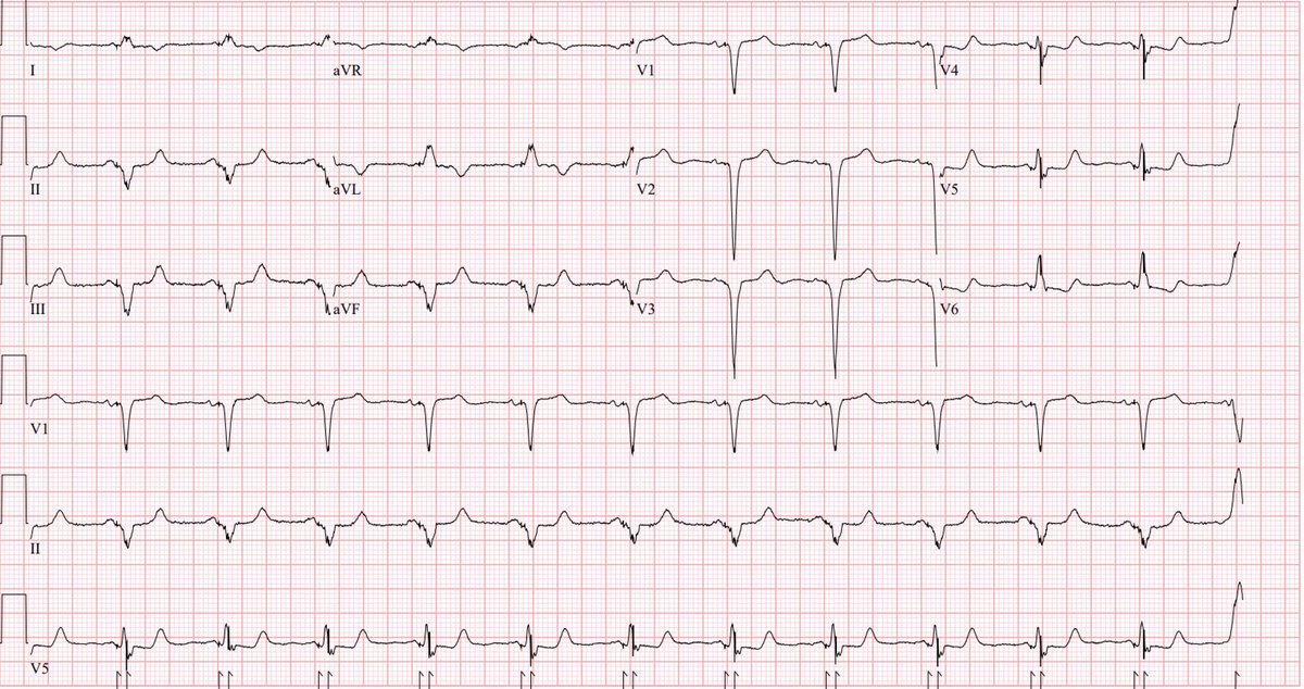 #LBBpacing #conductionsystempacing #dontdisthehis #EPeeps

Good example of LPF pacing. Unable to get good fixation or correction at basal/mid septum. Threshold initially very high but came down quickly (which is common).