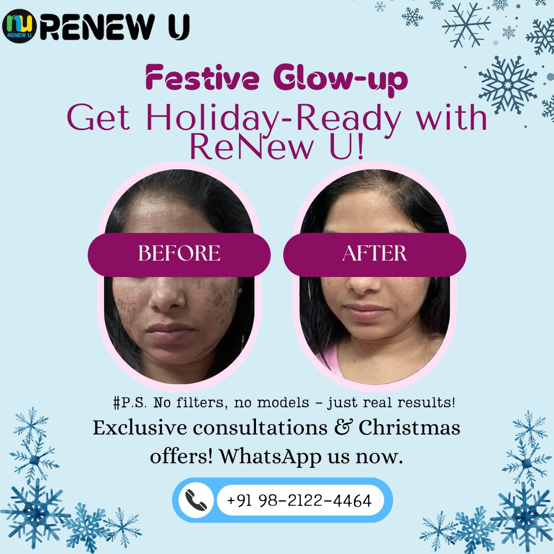 Renewu_world's tweet image. Holiday filter FOMO got you down? ✨ Skip the façade, get a real glow-up! 3-Day Festive Deals at #RenewU! Botox to hair transplants, chat experts on WhatsApp &amp;amp; win a touch-up!  First 20 get priority! #ShineBrighterNoida #ChristmasGlam