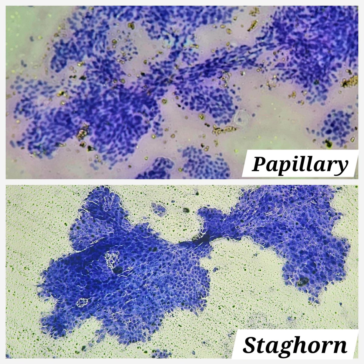 pkmadridista's tweet photo. Diagnosing a papillary lesion of Breast vs a fibroadenoma can often be tricky on cytology (or at least I find it so😜)
Here are some subtle hints which could help you in making a diagnosis in favour of papillary lesion of Breast over Fibroadenoma
1. Papillae (with central vessel) https://t.co/hYUTEV4vnw