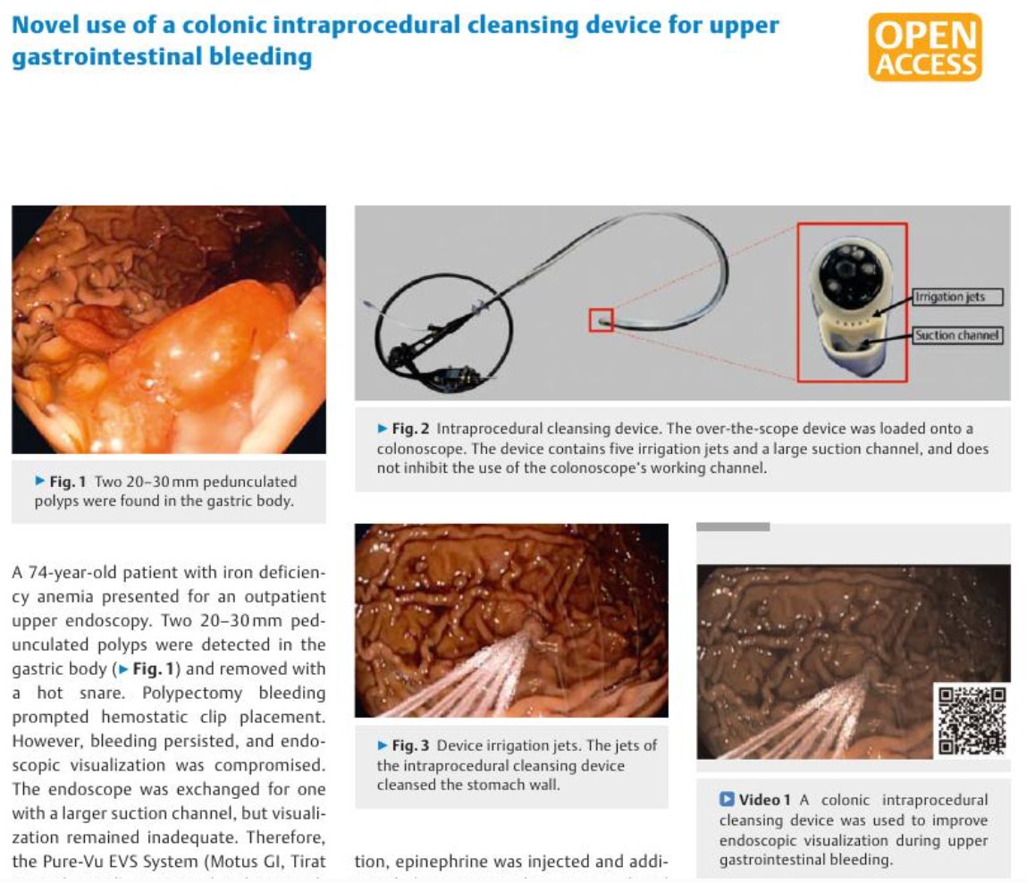 BJHansonMD's tweet image. @TGHermanMD presents how this intraprocedural cleansing device (designed for colon cleansing) saves the day by providing visualization in an iatrogenic arterial bleed resulting from large gastric polyp resection!

thieme-connect.com/products/ejour…