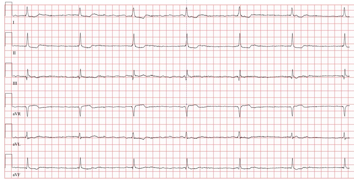 ecgandrhythmRoe's tweet photo. No chest pain, rhythm? Which medication is the patient probably taking? https://t.co/DZ488UyR7N