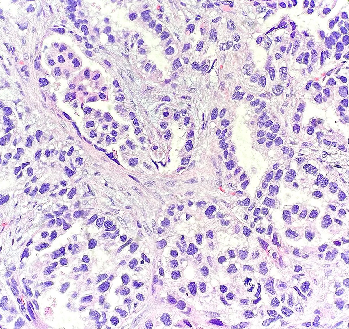 Lung resection containing a tumor revealing an EGFR p.L858R mutation. What was the morphologic diagnosis? What about therapy?  buff.ly/3tRgL8i #PathTwitter #MedTwitter #PathArt #MolPath