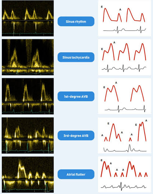 Impact of common rhythm disturbances on echocardiographic measurements and interpretation #ReviewArticle 

link.springer.com/article/10.100…
#CardioTwitter #cardiology #CardioEd #MedEd #echofirst