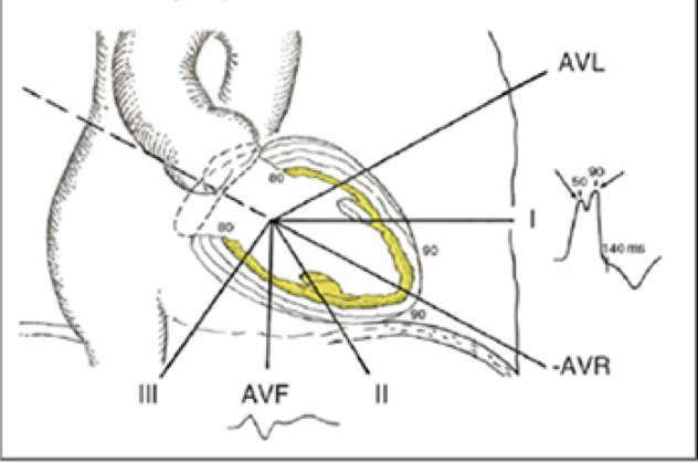 Very nice visual illustrating LBBB by Strauss et al. (PMID: 21376930) The 1st notch occurs approx 50ms after QRS onset & represents depolarization of the septal endocardium. The 2nd notch occurs when depolarization reaches epicardium of LV lateral wall #Epeeps #CardioTwitter