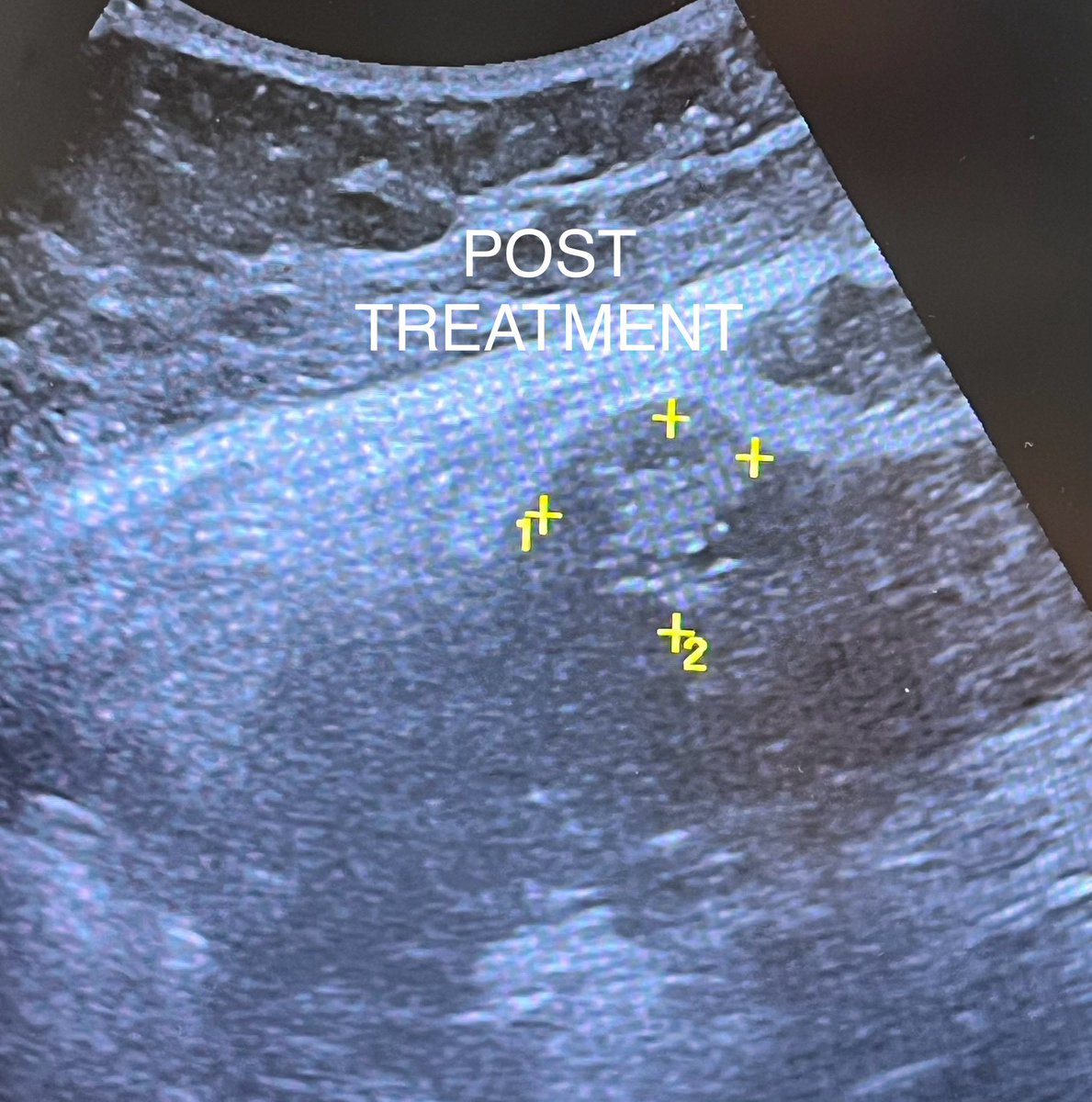 FAucejo's tweet photo. Histotripsy of small hepatocellular carcinoma. We welcome new, innovative and non invasive technologies. https://t.co/GUOxUhoLnM