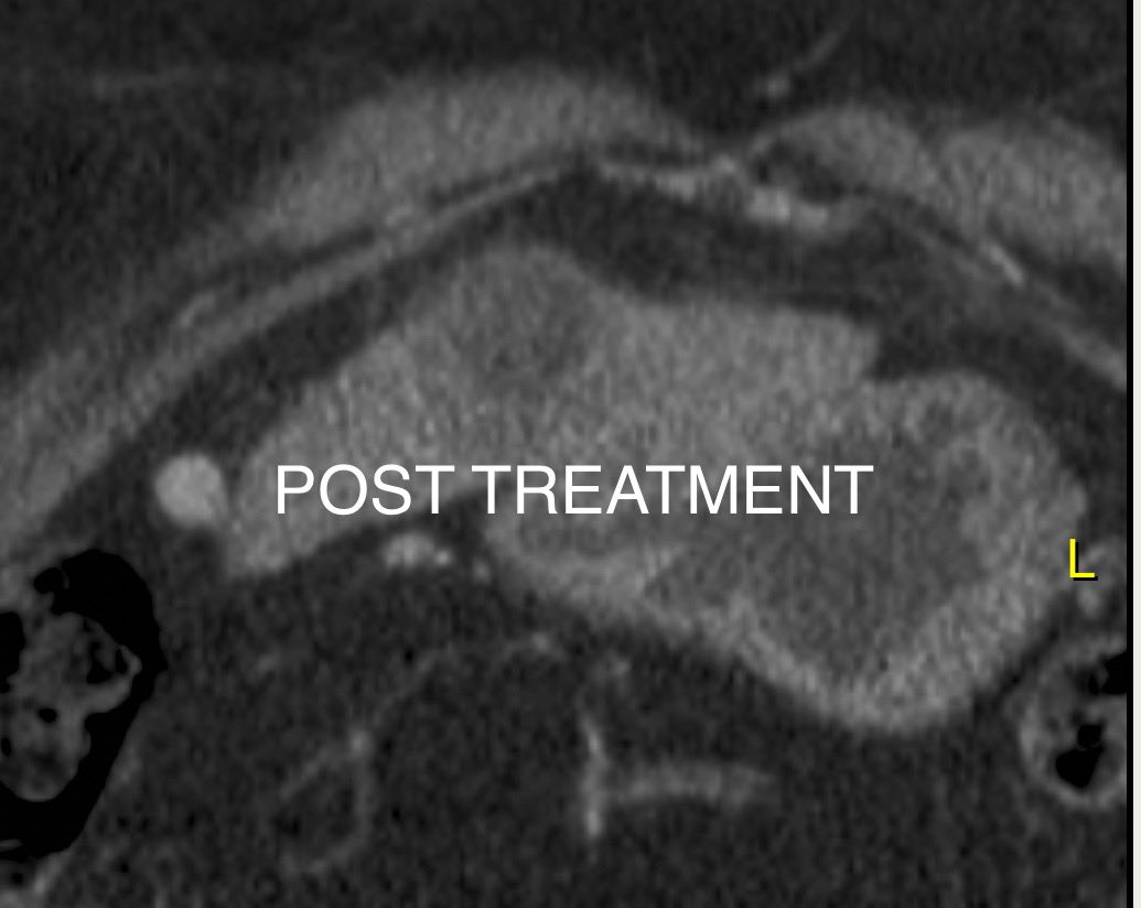FAucejo's tweet photo. Histotripsy of small hepatocellular carcinoma. We welcome new, innovative and non invasive technologies. https://t.co/GUOxUhoLnM