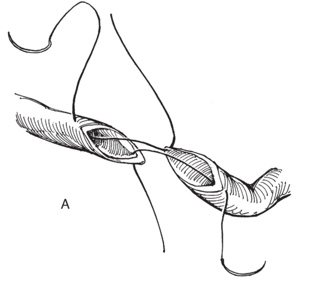 urojimenez's tweet photo. 🔷 Uretero-Uretero anastomosis 
(Nivel del cruce con los vasos iliacos) 
▪️Disección distal y proximal ➡️evitar tensión al aproximar bordes
▪️Preservar irrigación 
▪️Reavivar bordes 
▪️Espatular extremos
▪️Monofilamento absorbible 4-0
▪️Catéter JJ, 6 semanas https://t.co/MuYJsPti5m