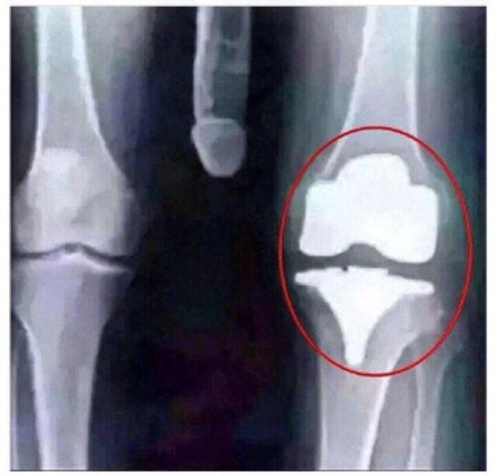 Me rompi la rodilla haciendo un doble gato 💔