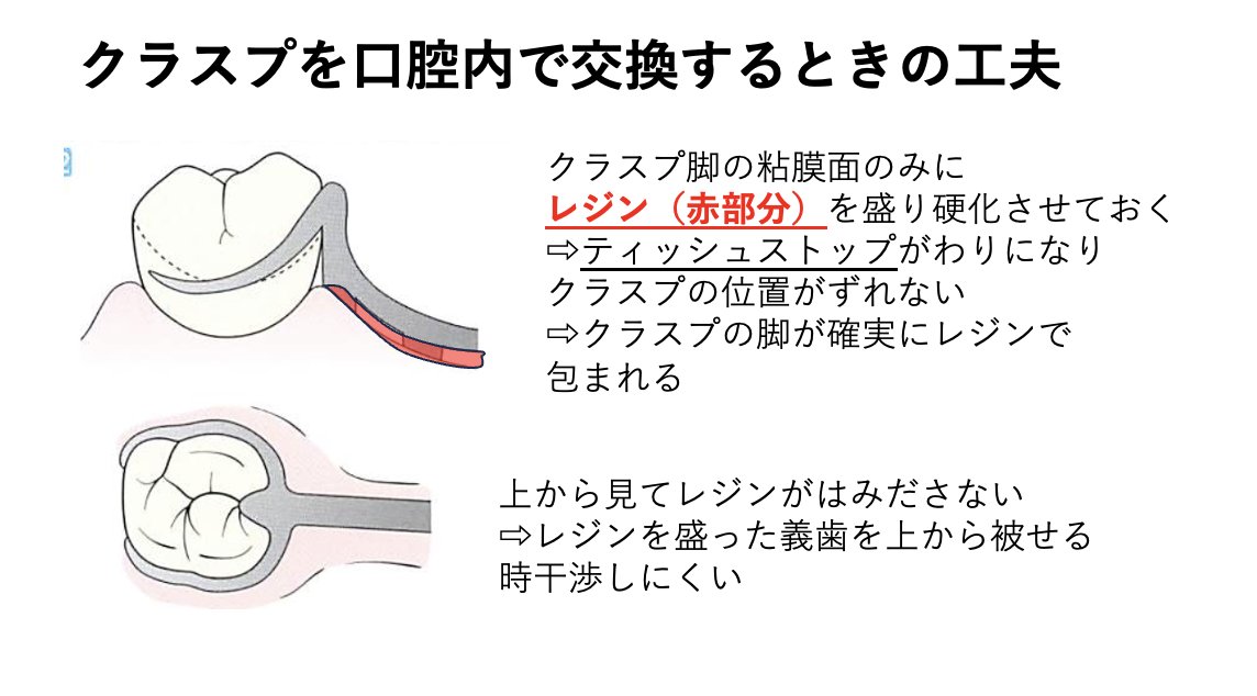 his_Dent's tweet image. クラスプ交換のちょっとしたこつ
鉤の交換は意外と難しい（着脱が早すぎると位置がズレるし、遅すぎるとアンダーカットにはまっちゃう）。
こういう時は、まず脚の内面に小さくレジンを盛って固めてティッシュストップがわりにする。そうするとクラスプがずれないし、確実にピックアップできる。