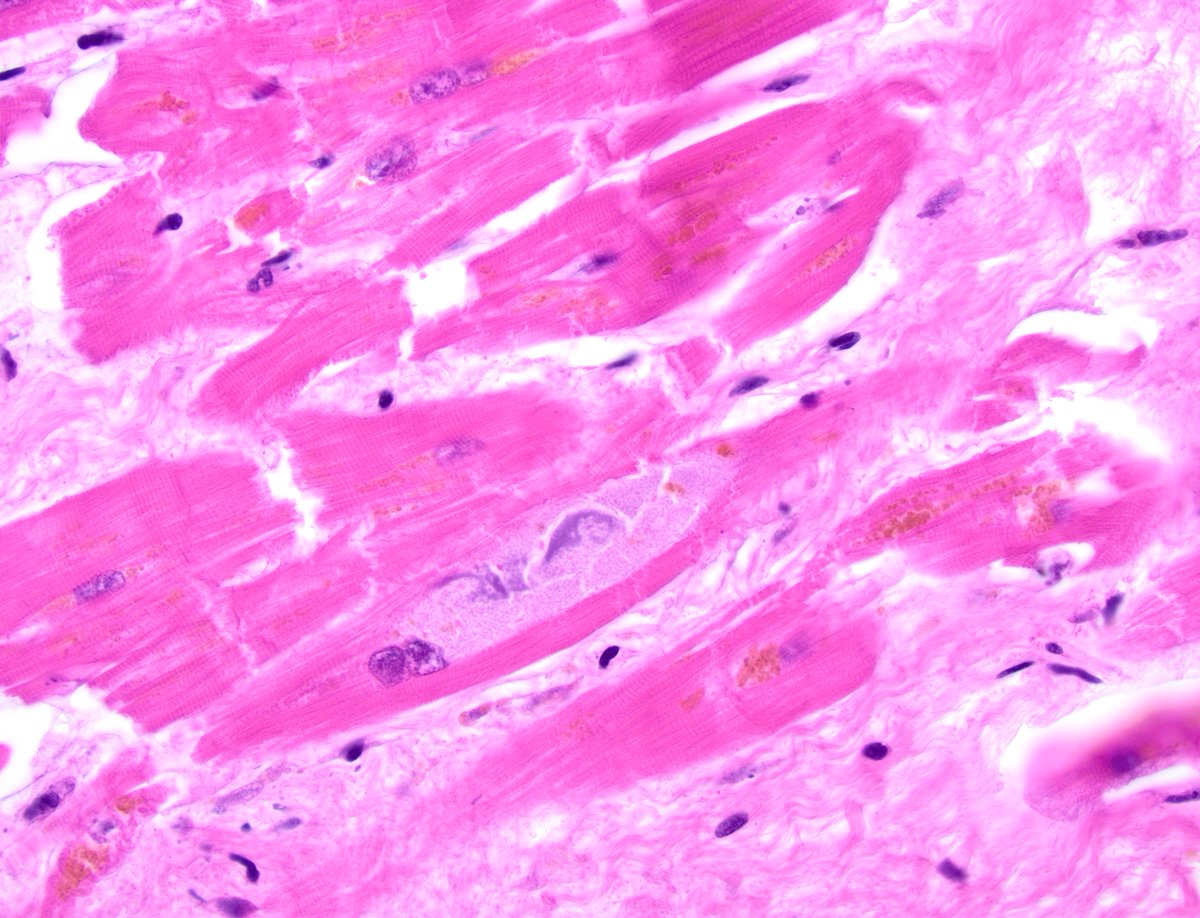 dgbrackett's tweet photo. Autopsy heart, older individual - basophilic degeneration?
I somehow had never heard of this until now (or learned & forgot??)
Benign age-related change🧓🫀
Is this too granular though?
#autopsy #cardiovascularpathology #cvpath @WKemp_MT_FPDoc @SCVP1 https://t.co/1YDOdb7iVe
