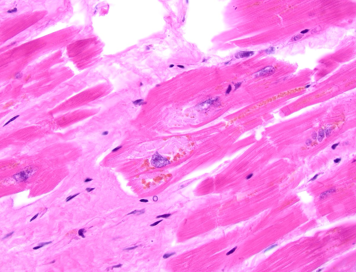 dgbrackett's tweet photo. Autopsy heart, older individual - basophilic degeneration?
I somehow had never heard of this until now (or learned & forgot??)
Benign age-related change🧓🫀
Is this too granular though?
#autopsy #cardiovascularpathology #cvpath @WKemp_MT_FPDoc @SCVP1 https://t.co/1YDOdb7iVe