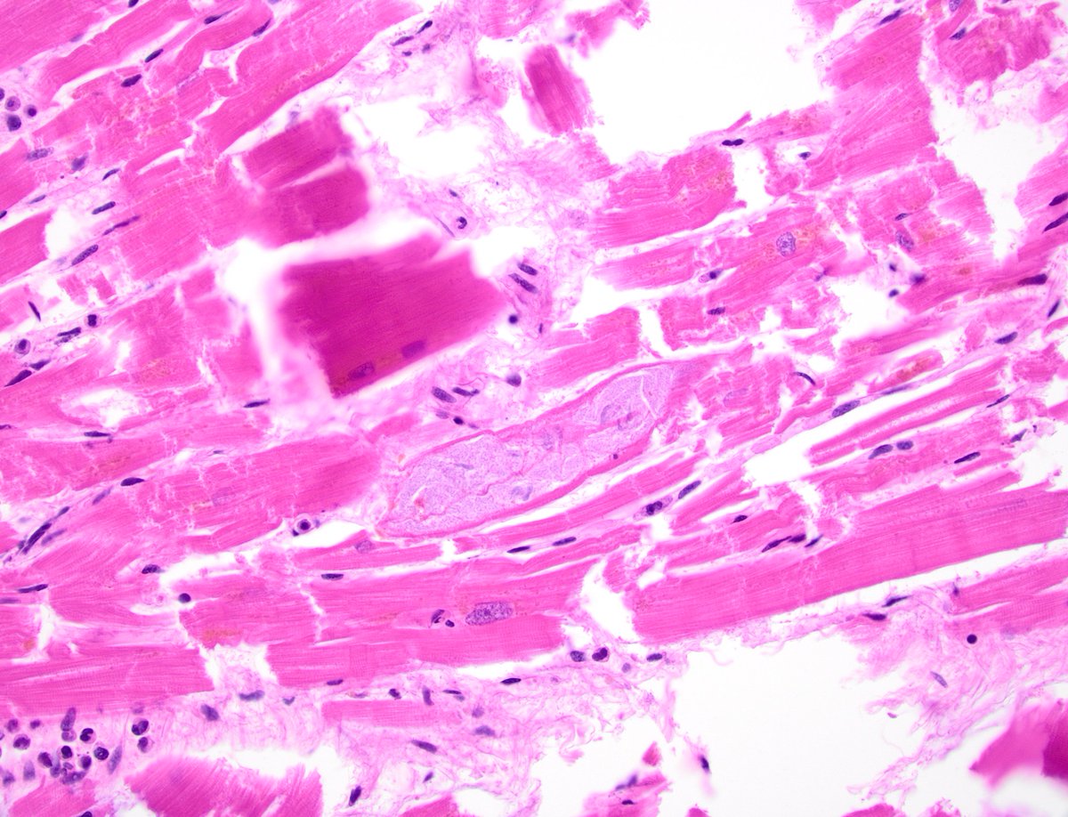dgbrackett's tweet photo. Autopsy heart, older individual - basophilic degeneration?
I somehow had never heard of this until now (or learned & forgot??)
Benign age-related change🧓🫀
Is this too granular though?
#autopsy #cardiovascularpathology #cvpath @WKemp_MT_FPDoc @SCVP1 https://t.co/1YDOdb7iVe