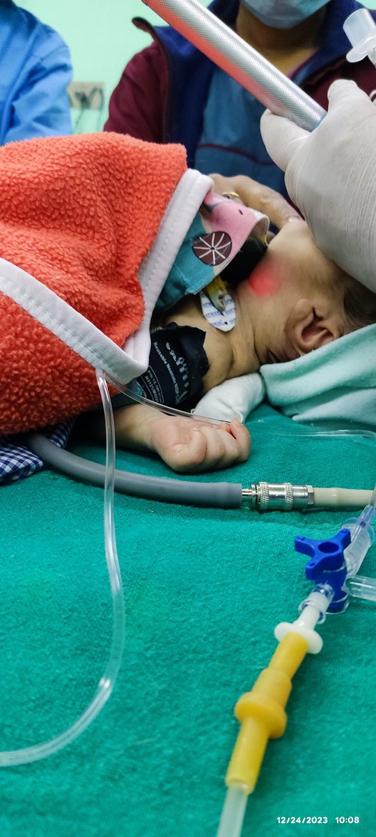 DrUtsavAcharya1's tweet photo. Neck roll in neonates
The most underappreciated, undertaught and undertransferred skill in neonatal airway mgmt
Consider-
*When to use ?
*How to use?
*Why to use?
*Most importantly, WHEN NOT TO USE ?
#pedanesthesia #TUTHanesthesia https://t.co/7K6f9ZdPVY