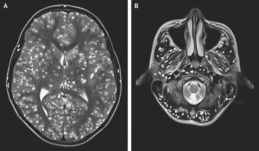 guerreroespejo's tweet photo. 18 años👨: confusión, convulsiones tónico-clónicas generalizadas.

RM: numerosas lesiones quísticas en toda la corteza (A) tronco cerebral y cerebelo (B).
1/3

DOI: 10.1056/NEJMicm1810953
#Neurología #radiología https://t.co/6yhkerZKHT