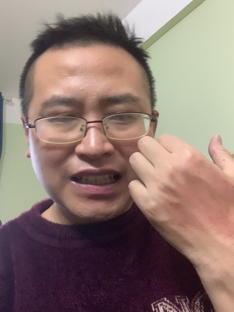 JamesCageWhite's tweet photo. what is happening to my hand 🤚 am I gonna die ? Hiv or Covid https://t.co/Kojhw8mOmS
