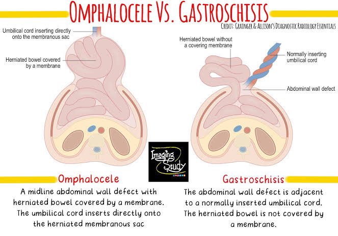 @modernHealthMe 👶Omphalocele 👉🏿 congenital abnormality 
Abdominal contents protrude into the peritoneal sac (diff. from gastroschisis which lacks a sac). Umbilical cord is attached to the sac👆🏿. 
Tx👉🏿 surgery
Image Credit: Imaging studies