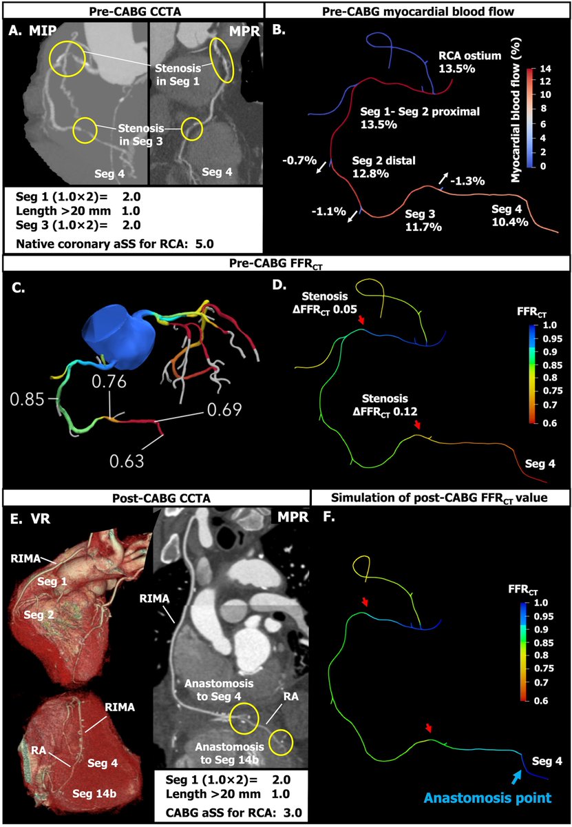 You will find the “origins” of #SYNTAX Score & #CABG SYNTAX Score AND “future directions” of decision-making for reasonable revascularization. 👉link.springer.com/article/10.100… #CCTA-based CABG SYNTAX Score Prospects of the quantitative assessment of myocardial perfusion after CABG ⬇️⬇️