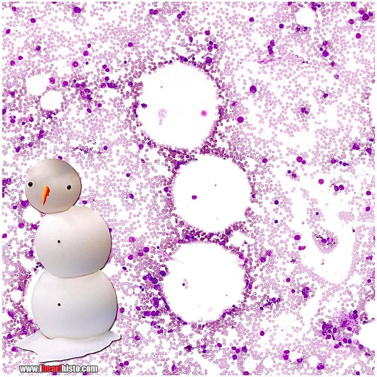⛄ Smear-sons Greetings⛄

A very seasonal smear made from red marrow extracted from the iliac crest of a pelvis.

Happy Holidays one and all!

#histology #anatomy #pathology #snowman