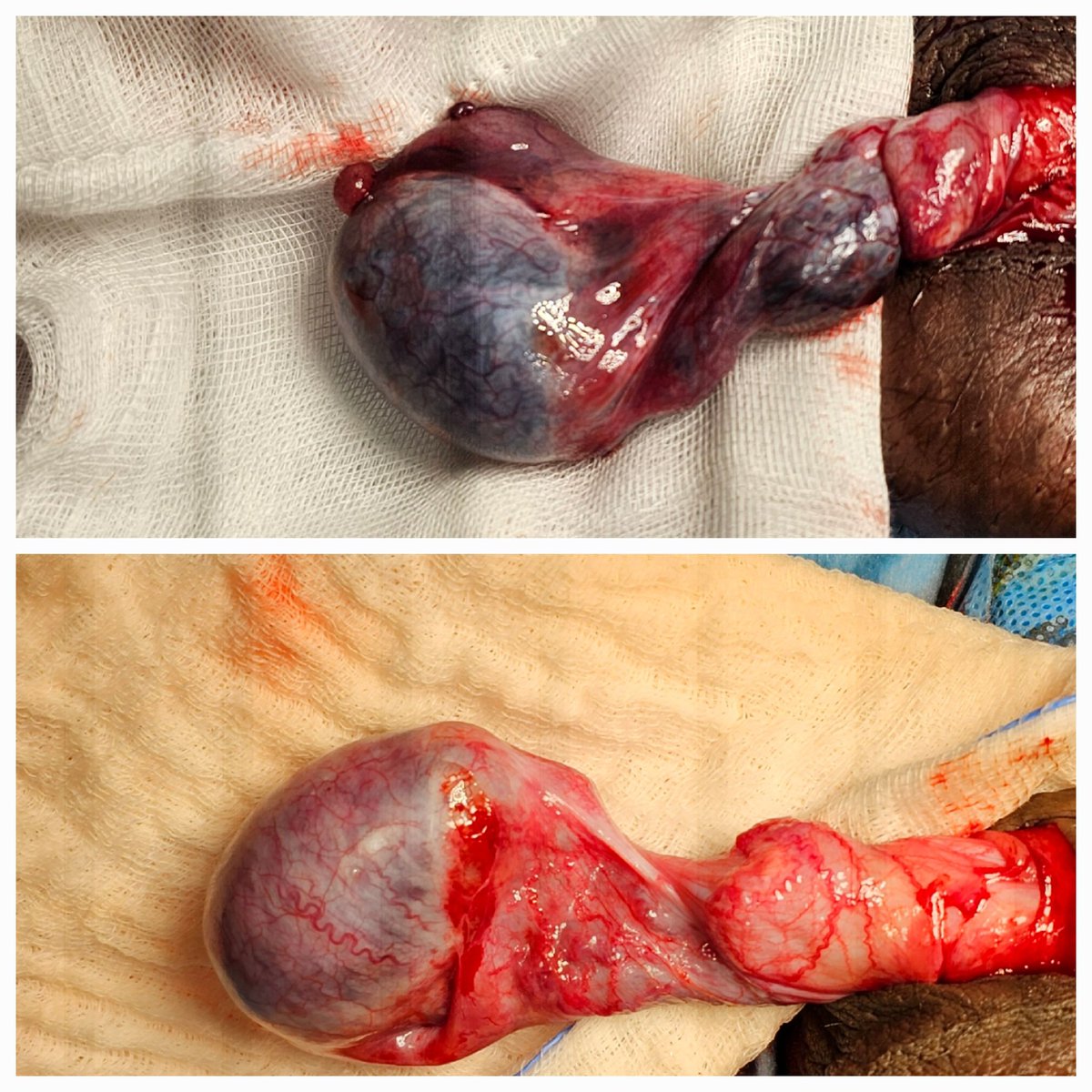 Acute torsion of testis, rare urological emergency that has to be attended within golden hours..happy that our team was able to save this 13yr old boy's testis