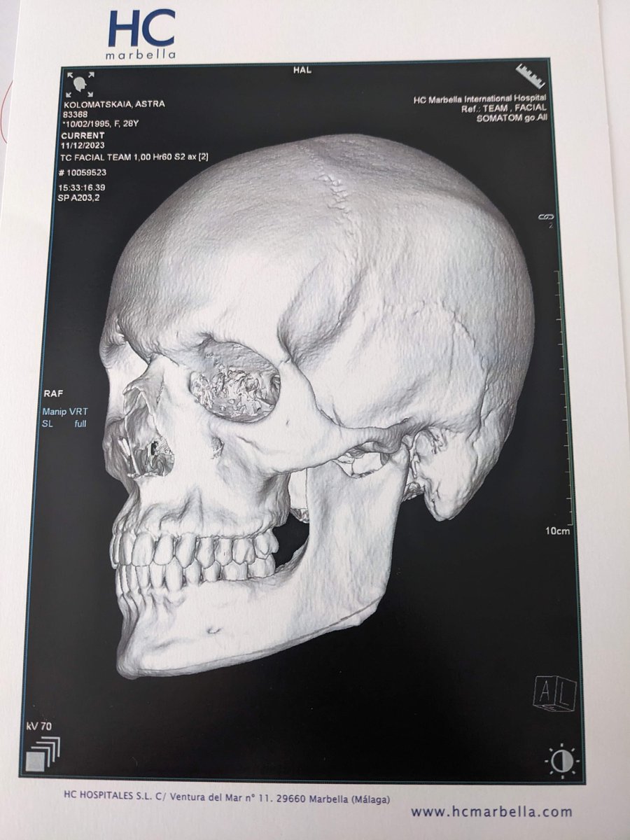 astradiol's tweet photo. Skull comparison time! #Facialteam

Unlike the previous photos, the results of this were fixed pretty soon after surgery

[I knew that my mouth was open for the second one would be an issue, but I was unfortunately mouth breathing at the time] https://t.co/ODtjXJ5iAq